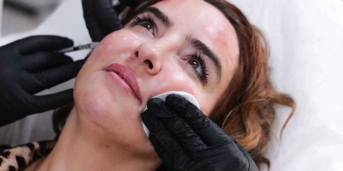 Achieve Radiant Skin with Cosmelan Peels in Auckland: The Ultimate Solution for Hyperpigmentation