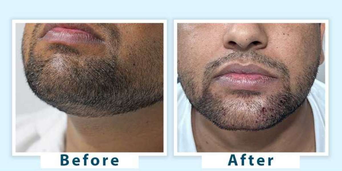 Best Natural Treatments to Prevent and Reduce Grey Beard Hair