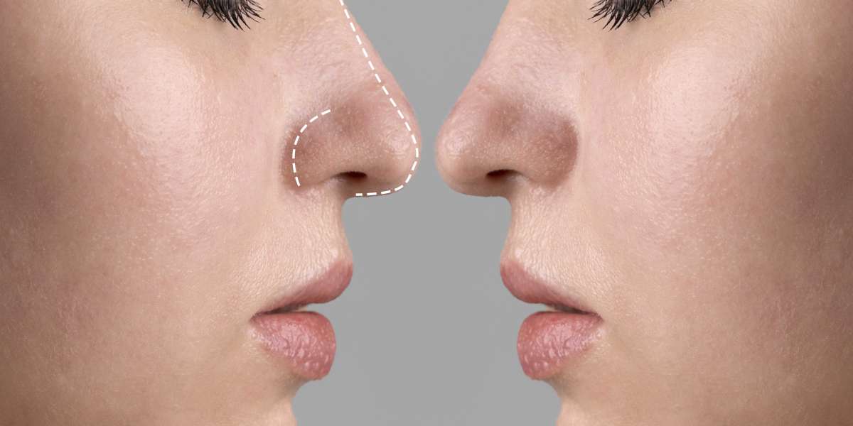 Transform Your Look with the Best Rhinoplasty Surgeon in Ludhiana