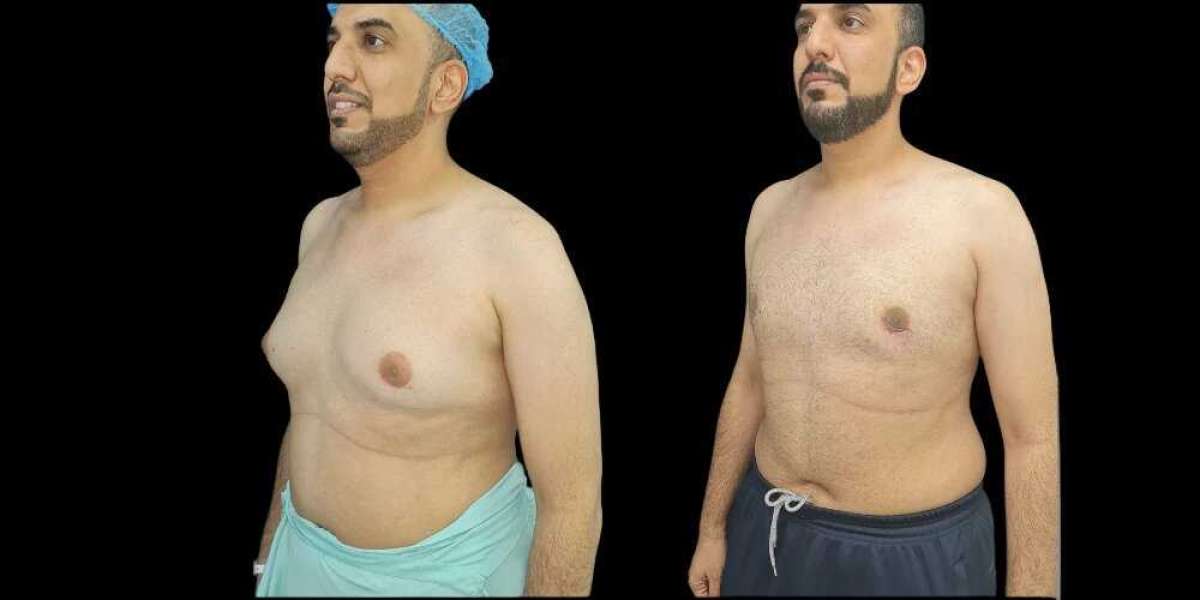 Is Surgery Right for You? Consulting the Best Gynecomastia Surgeons in Dubai