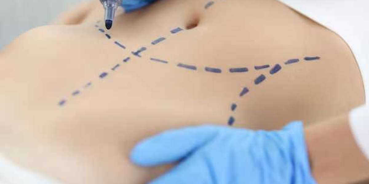 How Liposuction Can Transform Your Body Safely and Effectively