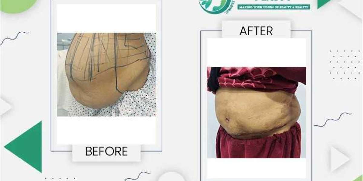 Tummy Tuck in Lahore: A Comprehensive Guide to Achieving a Flatter Abdomen