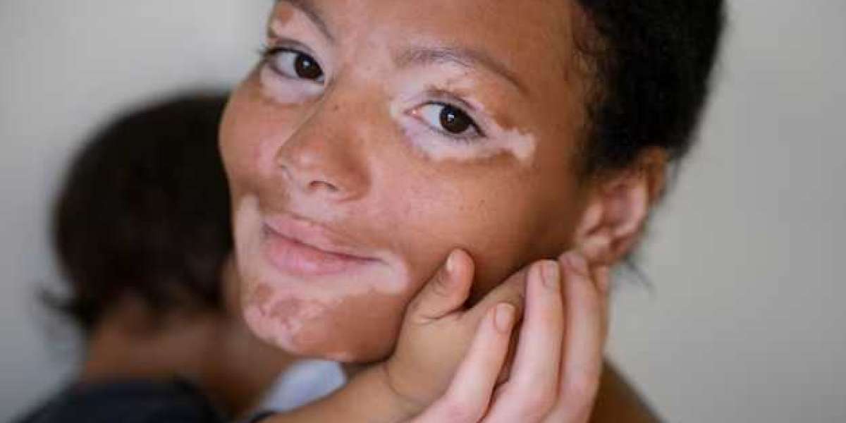 Effective Solutions for Managing Vitiligo: Personalized Care for Lasting Results