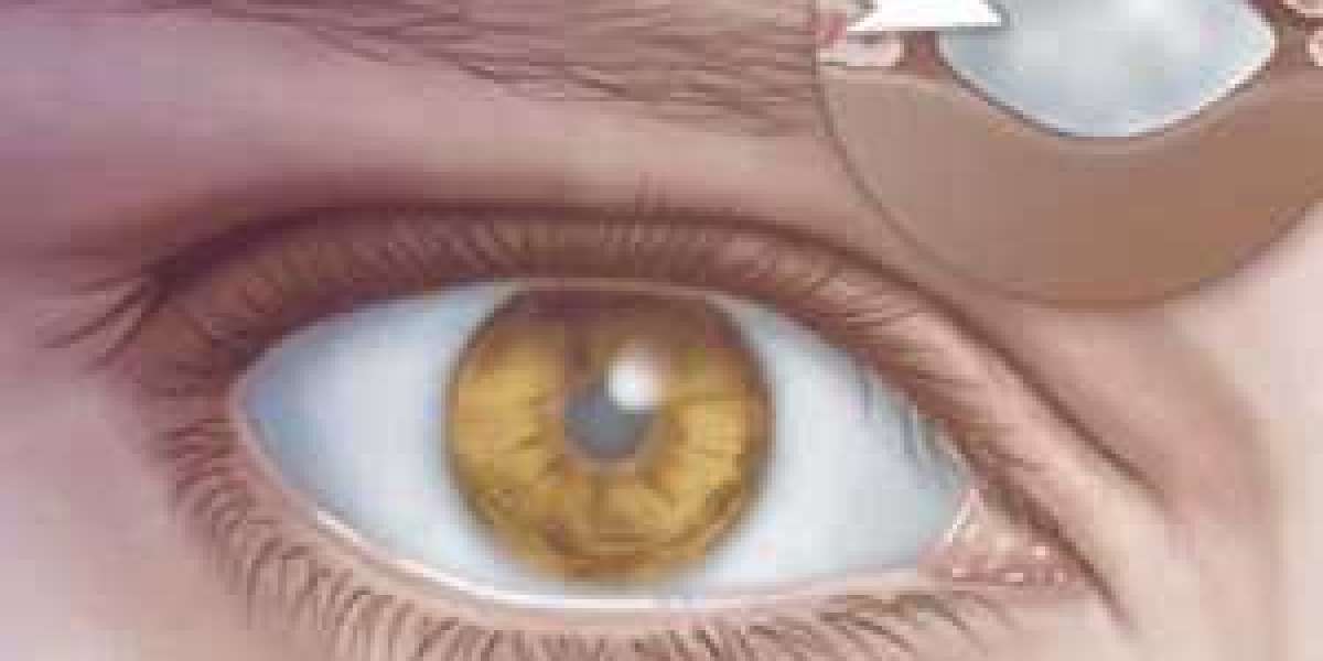 How To Find The Best Cataract Surgeon In Delhi