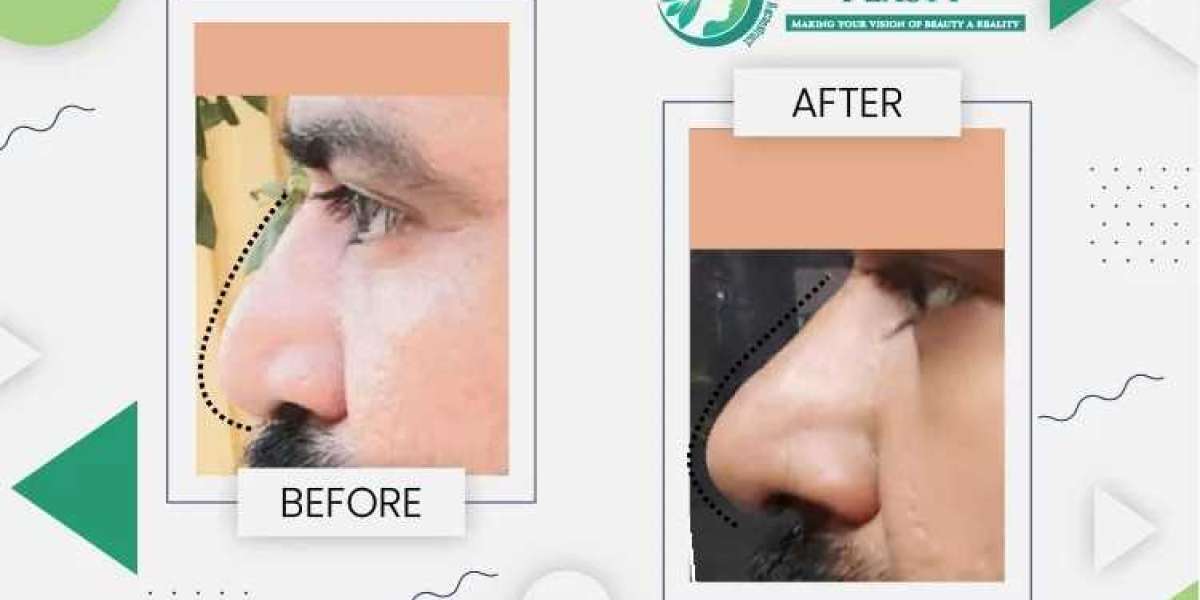 Choosing the Best Rhinoplasty Surgeon in Lahore: A Guide to Nose Surgery