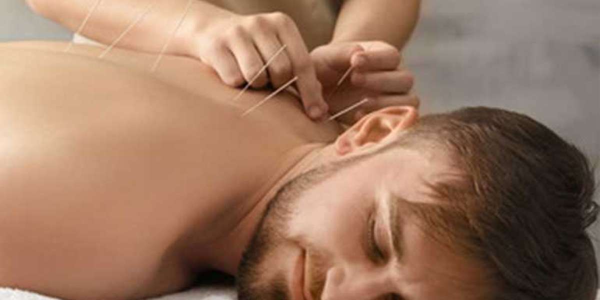 Acupuncture in St. Petersburg – A Time-Tested Approach to Wellness