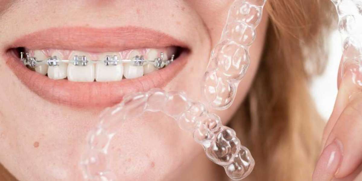 Invisalign Braces Costs: Is It More Affordable Than You Think?