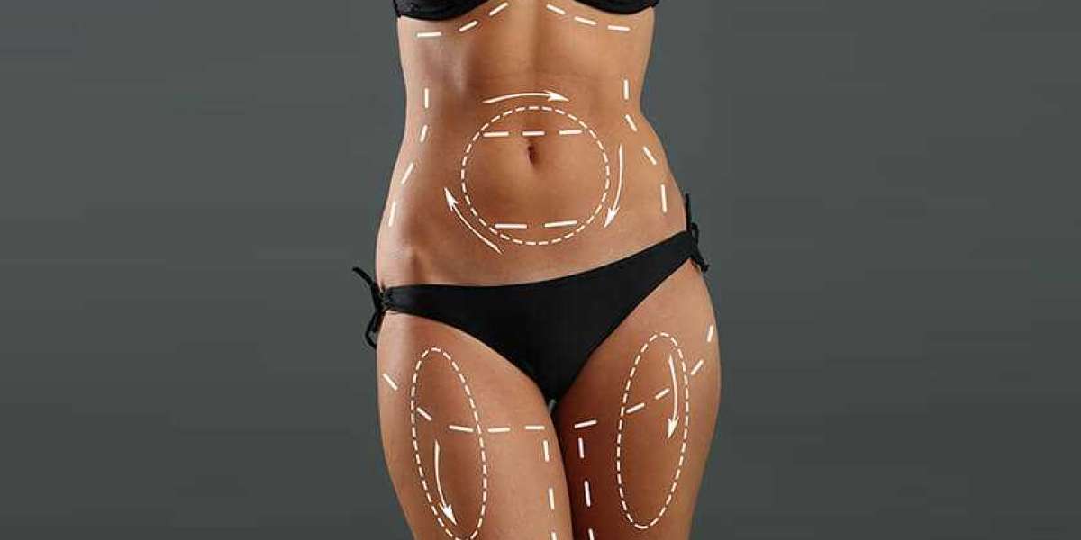 What to Expect Before and After Your Tummy Tuck Surgery